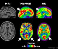 Evaluer les risques de maladie d’Alzheimer dès l’adolescence