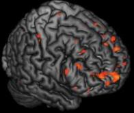 Explorer la « carte » de notre cerveau pour ouvrir la voie à la médecine personnalisée du futur