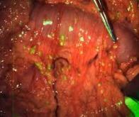 La chirurgie guidée par fluorescence, nouvel espoir pour soigner les cancers abdominaux