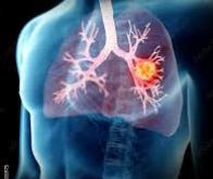 QAPHA, une nouvelle arme contre le cancer du poumon