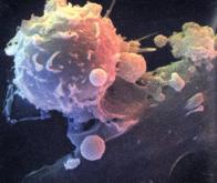 Une nouvelle immunothérapie efficace contre le cancer des os