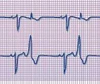 Une nouvelle protéine contre l'arythmie cardiaque