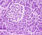 Cancer du pancréas : un nouveau protocole augmente sensiblement la survie...