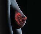 Cancer du sein triple-négatif : Curie lance un essai clinique pour un nouveau traitement