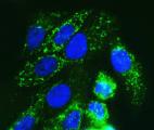 Cancer : un nouveau traitement anti-cancéreux ciblant une protéine spécifique