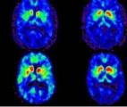 Détecter précocement la maladie de Parkinson grâce à l'IRM