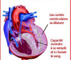 Insuffisance cardiaque ischémique : après un pontage coronarien, les ondes de choc améliorent la fonction myocardique