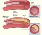L’excès de protéines est mauvais pour les artères