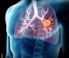 QAPHA, une nouvelle arme contre le cancer du poumon