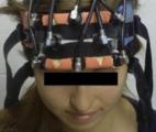 Un nouvel algorithme améliore la stimulation cérébrale profonde pour la maladie de Parkinson